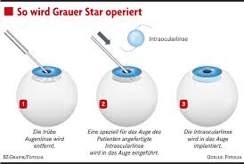 Eine Kunstliche Linse Hilft Patienten Mit Grauem Star Gesundheit Ernahrung Badische Zeitung