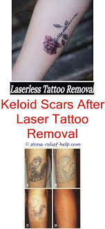 A series of injections will be used to relieve itching and other symptoms of the keloid and start to soften and shrink the scar. Invisible Ink Tattoo Removal