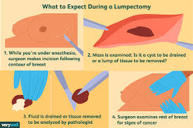 A clear, negative, or clean margin means there are no cancer cells at the outer edge of tissue that was removed. Breast Cancer Surgery Options And Differences