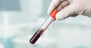 Schwangerschaftswoche ein ergebnis liefern, bei den invasiven methoden ist das erst ab der 11. Neuer Pranataler Bluttest Auf Einzelgenerkrankungen Kommt Auf Den