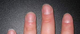 Kidney disease, or renal disease, also known as nephropathy, is damage to or disease of a kidney. Why Do Nails Have Ridges Office For Science And Society Mcgill University