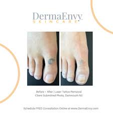 The latest in technology to deliver affordable and. Laser Tattoo Removal Remove Or Fade Unwanted Tattoos Birthmarks Dermaenvy Skincare Medical Aesthetics Laser Hair Removal And Skin Care Clinic