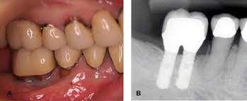 Cemental tear is defined as cementum fragment completely or partially detached from the root surface, and it has been associated with localized rapid periodontal breakdown. Cemental Tear A Case Report Of A Rare Root Fracture Journal Of Endodontics