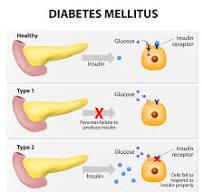 Type 2 diabetes: MedlinePlus Genetics