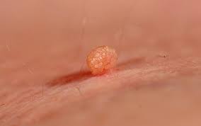 The tweezers are returned to the liquid nitrogen, and the process is replicated approximately three times. Skin Tags On Eyelids Causes And How To Remove Them