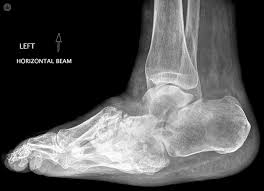 The bones are weakened enough to fracture, and with continued walking, the foot eventually changes shape. Charcot Foot What Is It Symptoms Causes Prevention And Treatment Top Doctors