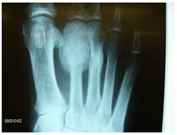 Bone cancer, or primary bone cancer, only includes cancers that start in the bone; Https Ispub Com Ijos 21 2 14697