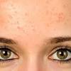 Hormonal acne forms as a result of fluctuations in hormones (often associated with your menstrual cycle) and usually occurs on the lower half of the face, particularly along the jaw or on the chin. 1