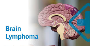 Talk to your medical team about ways to relieve any symptoms you have. Brain Lymphoma Symptoms Causes Diagnosis And Treatment