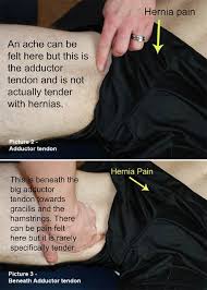 Is it a hernia or pulled muscle? Sports Hernia Symptoms Tests And Treatment Realbuzz Com