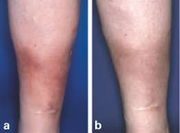 Image result for Lipodermatosclerosis