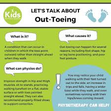 Image result for Out-toeing