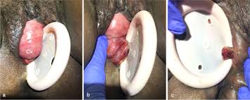 Image result for Pessary