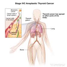 Thyroid cancer survivors' association, inc. Department Of Surgery Medullary Thyroid Cancer