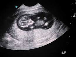Baby S First Ultrasound 11 Weeks 1 Day First Ultrasound Boy Ultrasound Pictures Baby Ultrasound Pictures