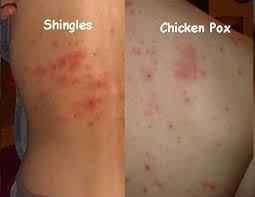 Image result for shingles in children