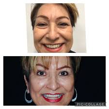 Eyelid Lift Albuquerque NM, D. Eric Tuggle, D.D.S.