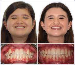 As a 48 year old adult I was nervous about getting braces. Dr. Cardall and  his staff were great and provided excellent care. Wound up not being as bad  as I thought.