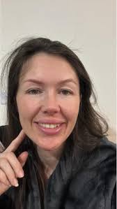 Did anyone do lower? I have hallows and dark circles. I was told this issue  is hard to correct. Did anyone else have similar issues and had success  with lower bleth? Dr