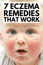 7 Eczema Remedies That Work Eczema Remedies Natural Eczema Remedies Home Remedies For Eczema
