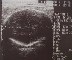 2nd and 3rd trimester ultrasound scanning