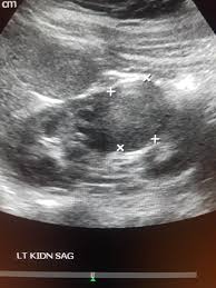 Renal Cell Carcinoma Renal Cell Carcinoma Renal Cell Ultrasound