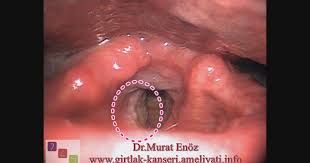 Gırtlak kanseri nedir, gırtlak kanseri belirtileri ve görüntüleri, gırtlak kanseri tedavisi ile ilgili tüm detaylar tek bir sayfada! Sag Ses Teli Kanseri Izlesene Com