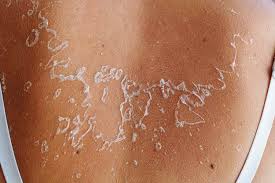 Image result for Sunburn