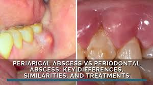 Image result for Periodontal Abscess