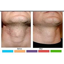 Lemon juice does not cause any adverse side effects and is quite safe for the skin. Buy Safecut Dr A Z Anti Razor Bump Ingrown Hair Formula 125ml For Women Men Best Treatment For Ingrown Hairs Acne Razor Bumps Razor Burn Use After Shaving Waxing Electrolysis