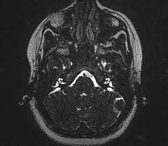 Large Vestibular Aqueduct Syndrome Radiology Case Radiopaedia Org