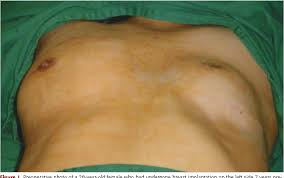 Poland syndrome is a disorder in which affected individuals are born with missing or underdeveloped muscles on one side of the body, resulting in abnormalities that can affect the chest, shoulder, arm. Figure 1 From Complication After Breast Implantation In Poland Syndrome Semantic Scholar