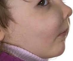 Vascular Anomalies of the Head and Neck