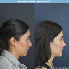 Nueva forma, misma esencia 🙂‍↔️ El resultado de una rinoplastia bien  planificada: natural, armónica y fiel al rostro de cada paciente. Agenda tu  valoración por WhatsApp al 5527532257 o envíanos un mensaje