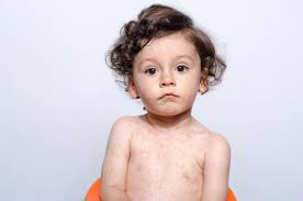 Image result for measles