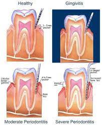 Gingivitis Is The Early Stages Of Gum Disease This Stage Usually Presents With Bleeding Swollen Gums When Plaque Gingivitis Gingivitis Symptoms Dental Facts