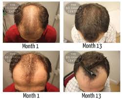 There are several different factors that can affect the follicles. Male Hair Loss Causes By Low Estrogen Hairloss Hairlosswomentreatments Hair Loss Men Hair Loss Women Hair Loss Medication