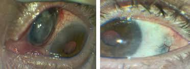 Image result for lesion sclera