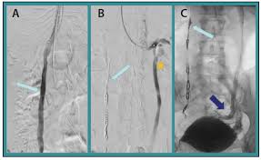 The only commercially available sodium tertradecyl sulfate injection in the u.s. Treatment Strategies For Varying Patterns And Presentations Of Pelvic Venous Disorder Endovascular Today