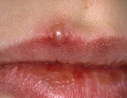 It looked like it may be the beginning of a pimple or a cold sore. Cold Sores Vs Canker Sores Vs Chancres