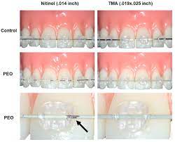 Materials Free Full Text Surface Characteristics Of Esthetic Nickel Titanium And Beta Titanium Orthodontic Archwires Produced By Plasma Electrolytic Oxidation Peo Primary Results