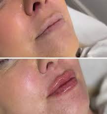 New Lips for this first timer 💋 Patch Test required Boom Online ⬇️  dawnonlaesthetics.book.app