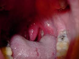 Pautas Cortas En Faringitis Grupo De Infecciosas Somamfyc