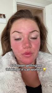 CO2 laser the burn is real #co2 #burning #hair #acne #scar