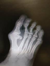 Broken big toe xray pictures. Fractured Hallux Stubbed Big Toe Or Broken Big Toe Best Treatment