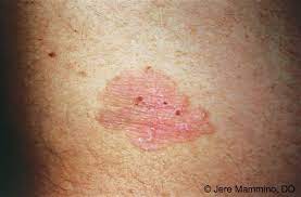 Treatment it is very important to start the treatment of this disease as soon as the symptoms are diagnosed and the disease is confirmed. Bowen S Disease American Osteopathic College Of Dermatology Aocd