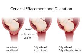 Dilation Of Cervix During Labour Delivery