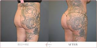 The buttock is first contoured by performing liposuction in the areas around the buttocks to make them stand out more. Brazilian Butt Lift How Big Should I Go