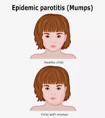 Image result for Mumps