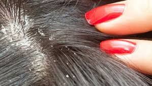 Dermatoloji Uygulamalari Sac Bitlenmesi Doktortakvimi Com